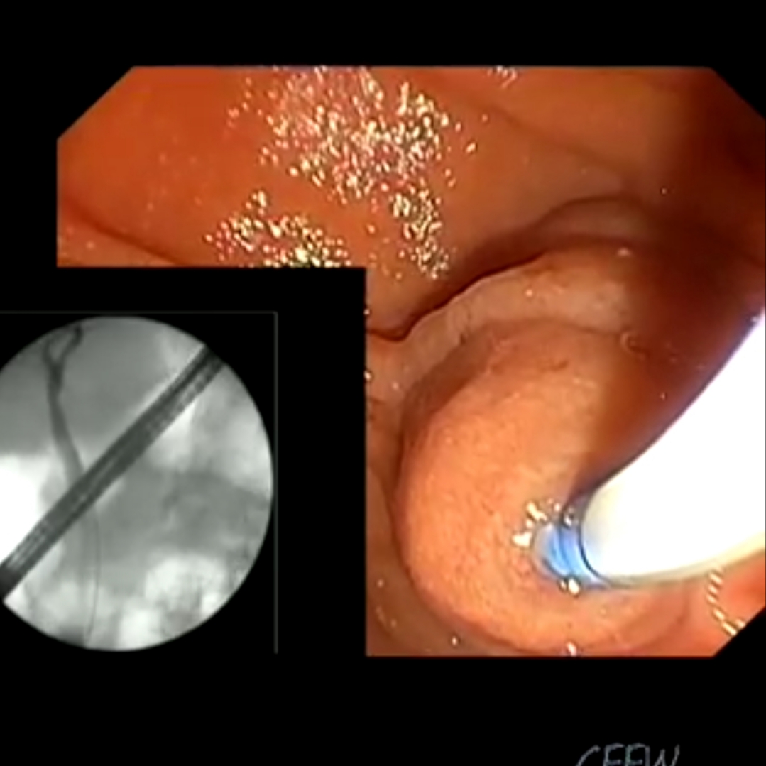 ERCP